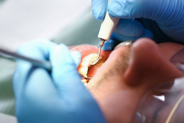 Best Emergency Dentist for Knocked-Out Tooth in Pigeon, MI