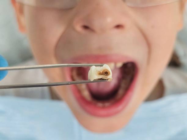Best Emergency Root Canal Treatment in Pigeon, MI